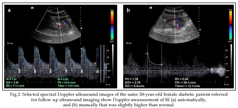 Fig.2: Selected spectral Doppler ultrasound images of the same 50-year-old female diabetic patient referred for follow up ultrasound imaging show Doppler measurement of RI (a) automatically, and (b) manually that was slightly higher than normal. Fig.2: Selected spectral Doppler ultrasound images of the same 50-year-old female diabetic patient referred for follow up ultrasound imaging show Doppler measurement of RI (a) automatically, and (b) manually that was slightly higher than normal.